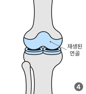 재생된 연골