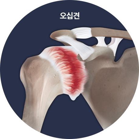오십견